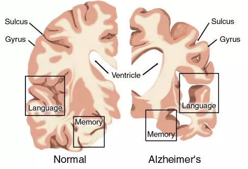 AD药物研发现状：辉瑞、礼来、百健、诺华、强生……