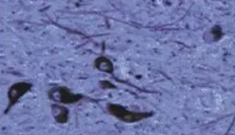 正常人：黑质神经元存在