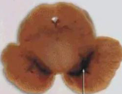 正常人：正常黑质