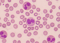 一种神秘颗粒被发现了！它能否成为败血症早筛标志物？