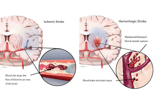 世界卒中日：从动物药效模型评价看心脑血管药物开发